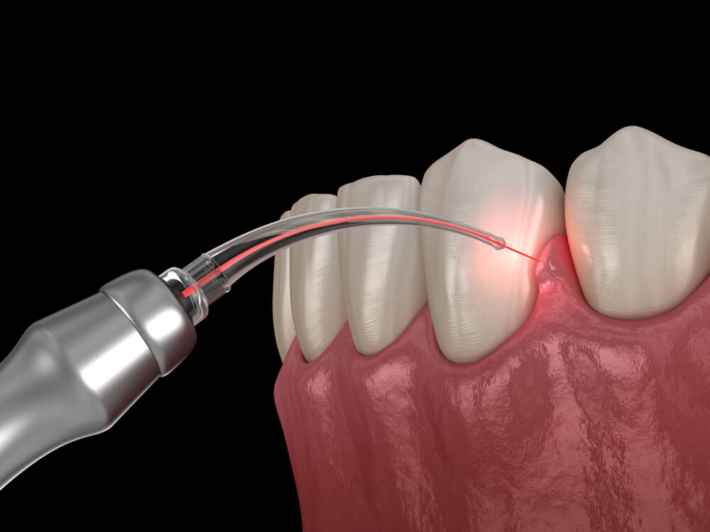 The Precision of Laser Technology