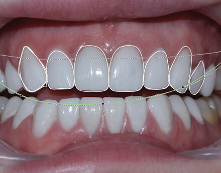 The Arizzta Approach to DSD: Empowering You to Shape Your Smile